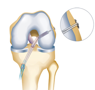 anteriorcruciateligament